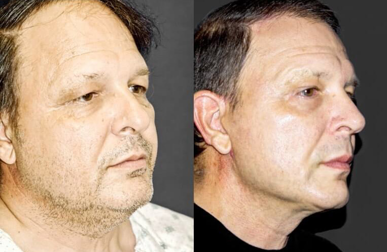 Face and necklift including cheeklift with canthopexy, LiveFill to nasolabial folds and marionette lines, buccal fat pad excision, upper bleparoplasty, minimally invasive temporal/anterior hairline, lateral browlift, rhinoplasty with tip plasty and right external nasal valvuloplasty.
