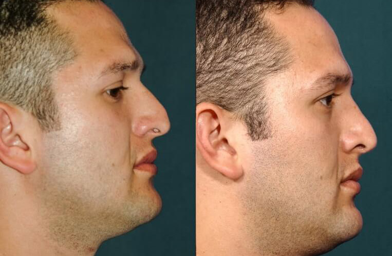 Open rhinoplasty, dorsal reshaping, osteotomy with correction of fracture & septal trim