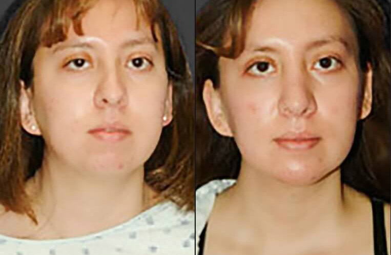 Buccal fat pad removal and submental liposculpture with rhinoplasty.