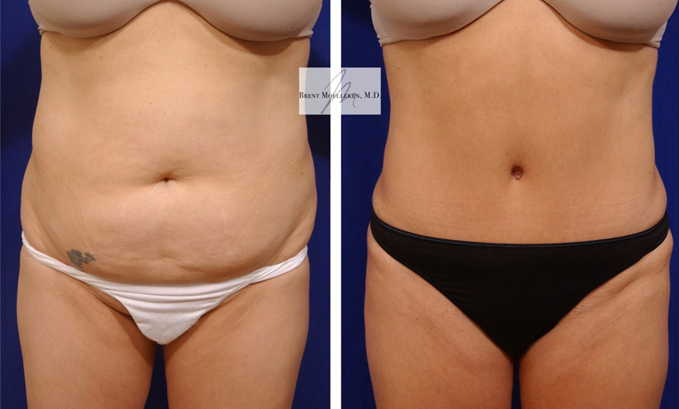 Tummy Tuck with Liposuction to Abdomen and Flanks