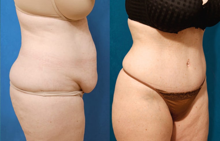 Tummy Tuck with Flank Extension, Diastasis Repair, Liposuction to Abdomen and Flanks