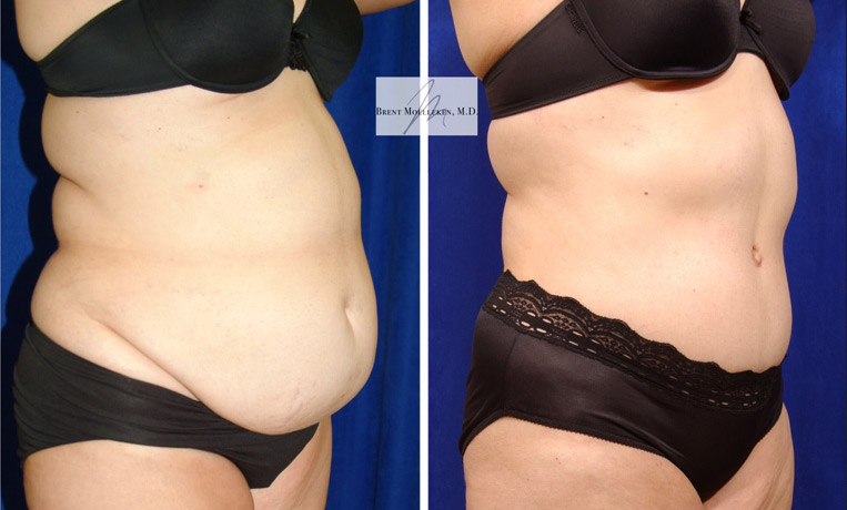 Tummy Tuck with Flank Extension, Liposuction to Abdomen and Flanks