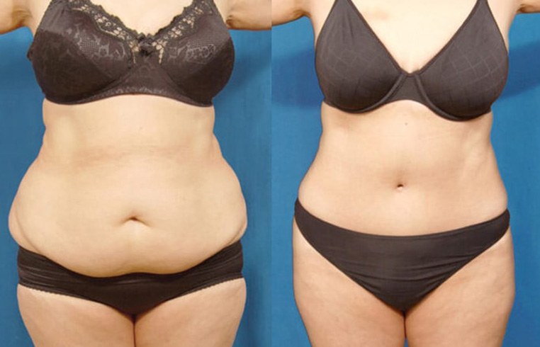 Full abdominoplasty with liposculpture to flanks, abs, and waist.
