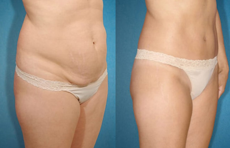 Abdominoplasty tummy tuck with liposculpture of abs and flanks