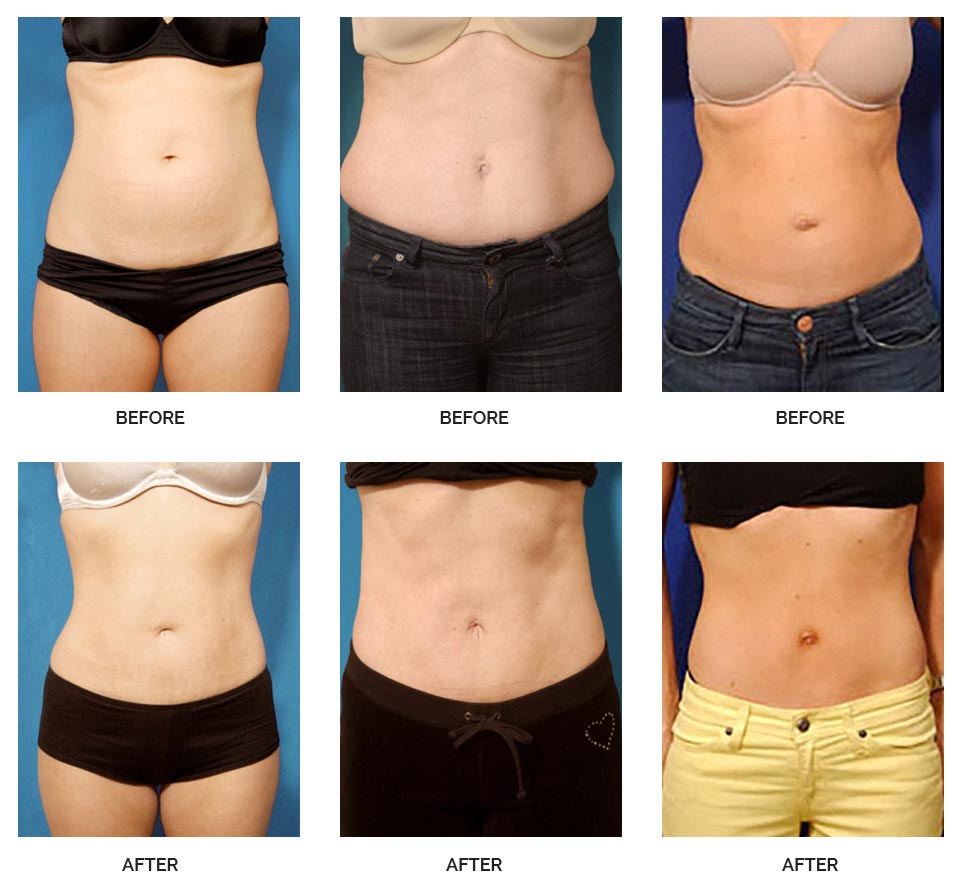 hybrid tummy tuck before and after 1a