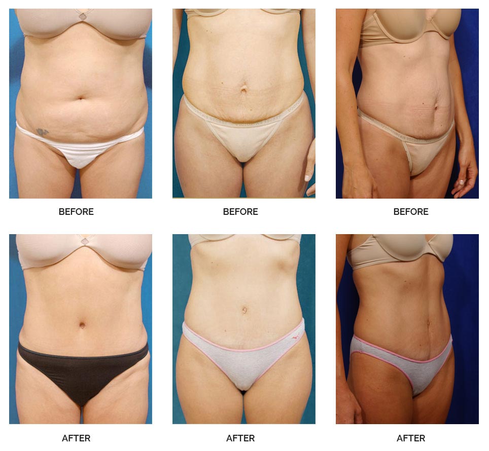 hybrid tummy tuck before and after 1b