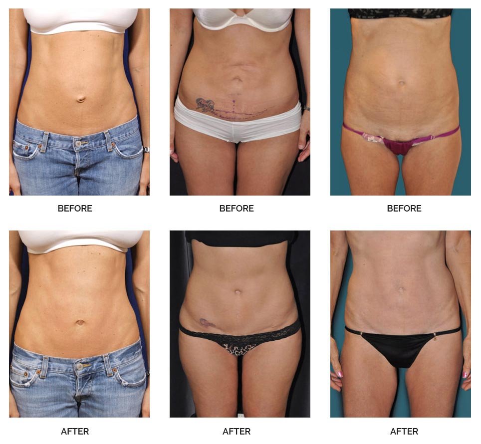 hybrid tummy tuck before and after 1c