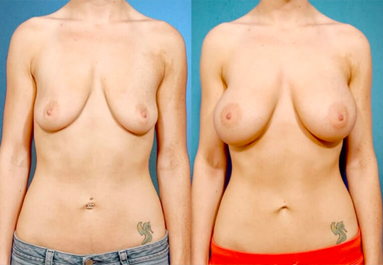 Breast augmentation with smooth saline implants, size 300cc – subpectoral placement/inframammary incision.