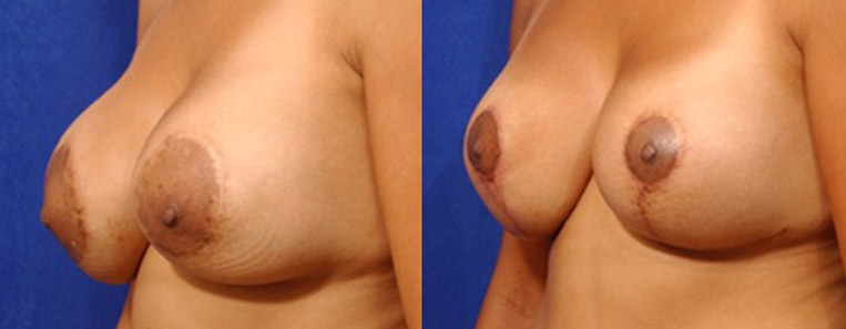 Breast and Nipple Reduction