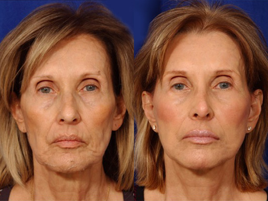 Facelift Necklace, USIC Cheeklift, Lateral Browlift, Livefill to Nasolabial Folds and Lips, Upper Lip Lift, Rhinoplasty Co2 Laser