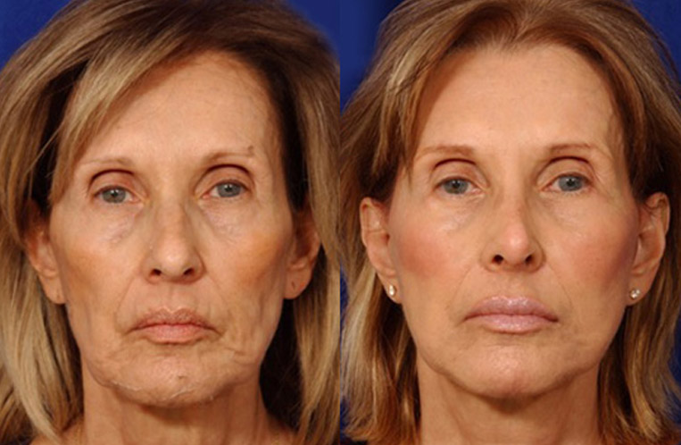 Facelift with Necklace, USIC Cheeklift, Lateral Browlift, Livefill to Naso Labial Folds and Lips, Upper Lip Lift, Rhinoplasty, Co2 Laser