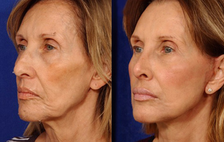 Facelift with Necklace, USIC Cheeklift, Lateral Browlift, Livefill to Naso Labial Folds and Lips, Upper Lip Lift, Rhinoplasty, Co2 Laser