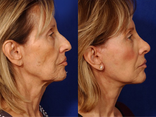 Facelift Necklace, USIC Cheeklift, Lateral Browlift, Livefill to Nasolabial Folds and Lips, Upper Lip Lift, Rhinoplasty Co2 Laser