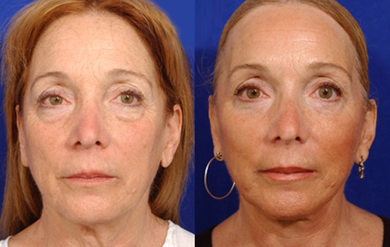 Facelift with Necklace, Lateral Browlift, USIC Cheeklift with Transconjunctival Lower Blepharoplasty, Livefill to Lips, Livefill to Nasolabial Folds, Co2 Laser to Face.