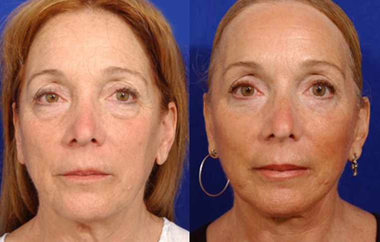 Facelift with Necklace, Lateral Browlift, USIC Cheeklift with Transconjunctival Lower Blepharoplasty, Livefill to Lips, Livefill to Nasolabial Folds, Co2 Laser to Face.