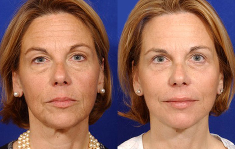 Facelift with Necklace, USIC Cheeklift, Lateral Browlift, Livefill to Naso Labial Folds and Lips, Upper Lip Lift, Rhinoplasty, Co2 to Face and Neck