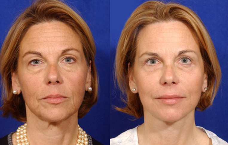 Facelift with Necklace, Lateral Browlift, USIC Cheeklift with Transconjunctival Lower Blepharoplasty, Livefill to Lips, Livefill to Nasolabial Folds, Co2 Laser to Face