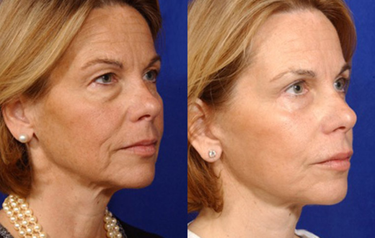 Facelift with Necklace, USIC Cheeklift, Lateral Browlift, Livefill to Naso Labial Folds and Lips, Upper Lip Lift, Rhinoplasty, Co2 Laser to Face and Neck