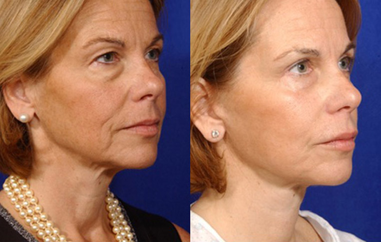 Facelift with Necklace, Lateral Browlift, USIC Cheeklift with Transconjunctival Lower Blepharoplasty, Livefill to Lips, Livefill to Nasolabial Folds, Co2