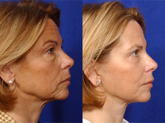 Facelift with Necklace, Lateral Browlift, USIC Cheeklift with Transconjunctival Lower Blepharoplasty, Livefill to Lips, Livefill to Nasolabial Folds, Co2 to Face and Neck
