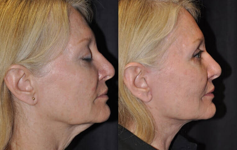 Facelift with Necklace © and upper blepharoplasty.