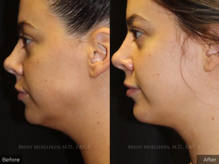 31 yr old Female Lipo+ Facetite to jawline