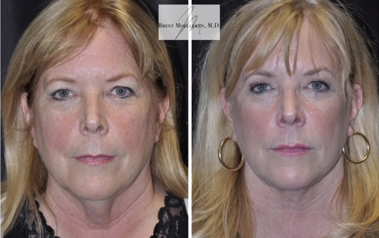 Facelift with Necklace, Lateral Browlift, USIC Cheeklift, Transconjunctival Lower Blepharoplasty, Co2 Laser to Face