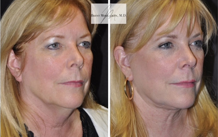 Facelift with Necklace, Lateral Browlift, USIC Cheeklift, Transconjunctival Lower Blepharoplasty, Co2 Laser to Face