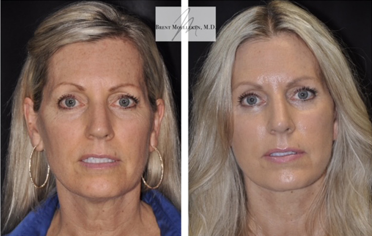 Facelift with Necklace, USIC Cheeklift, Upper Blepharoplasty, Livefill to Nasolabial Folds and Lips, Upper Lip Lift, Co2 Laser to Face, Rhinoplasty