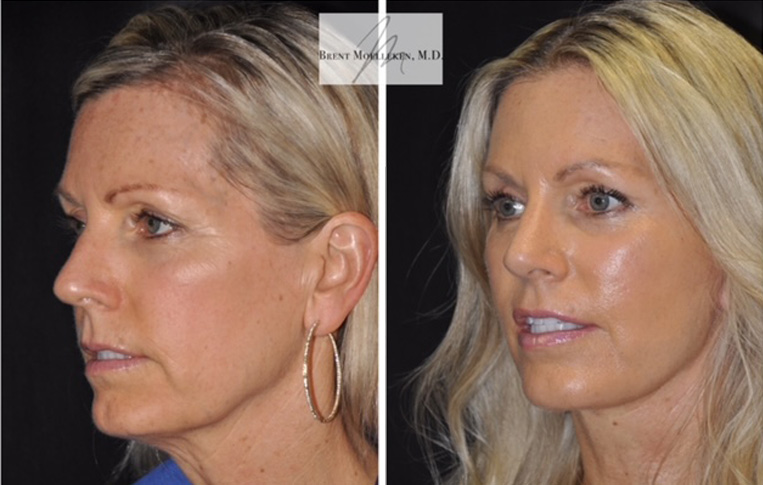 Facelift with Necklace, USIC Cheeklift, Upper Blepharoplasty, Livefill to Nasolabial Folds and Lips, Upper Lip Lift, Co2 Laser to Face, Rhinoplasty