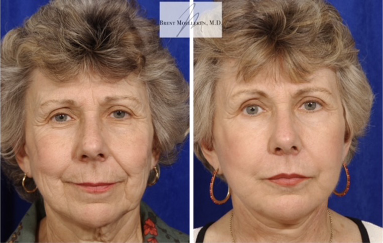 Facelift with Necklace, USIC Cheeklift, Upper Blepharoplasty, Lateral Browlift, Livefill to Nasolabial Folds and Lips, Upper Lip Lift, Co2 Laser Resurfacing