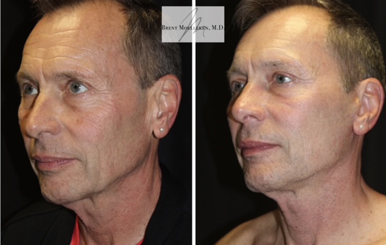 Facelift, Necklace, Co2 Laser to Face