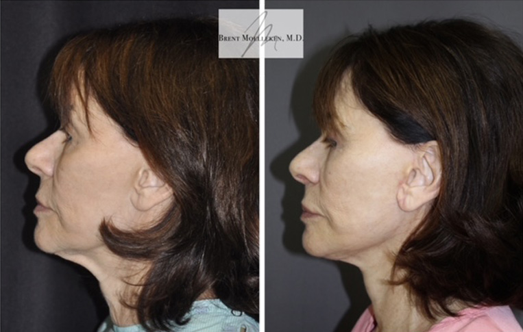 Facelift with Necklace, USIC Cheeklift, Upper Blepharoplasty, Livefill to Lips, Livefill to Cheeks, Gullwing Lip Lift, Co2 Laser to Face