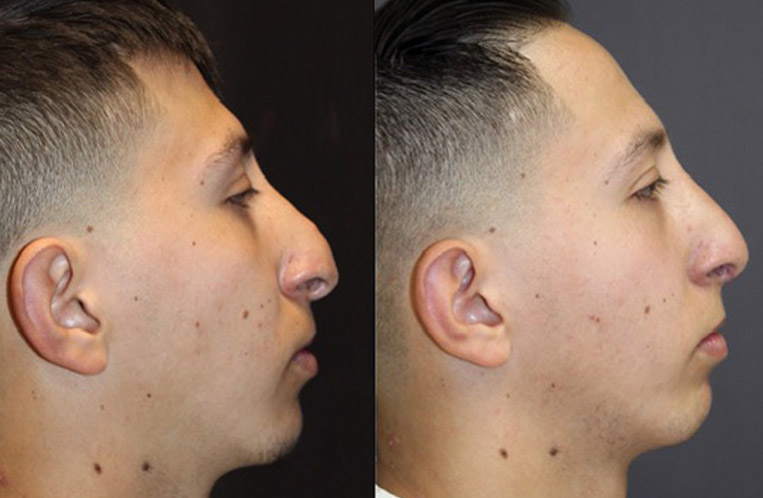 Severe Congenital Nose Reconstruction