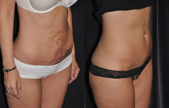Modified Tummy Tuck with Vertical Incision
