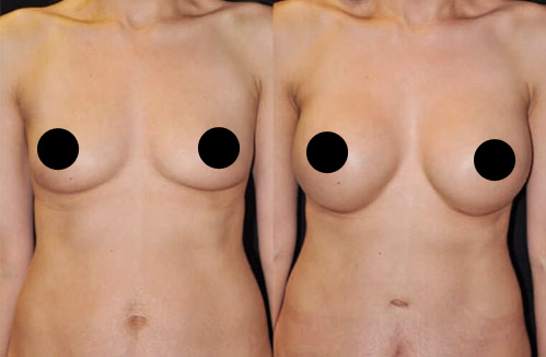 Breast augmentation procedure - Before and after picture of a patient