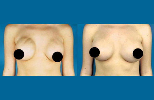 Breast implant revision procedure - Before and after picture of a patient