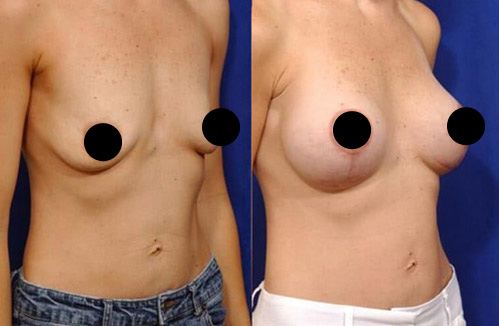 Breast lift procedure - Female patient before and after picture side view