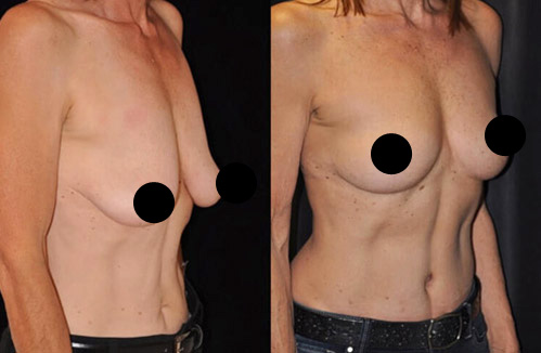 Breast lift procedure - Female patient before and after picture side view