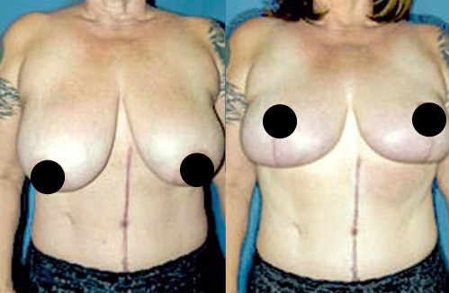 Breast reduction procedure - Female patient before and after picture