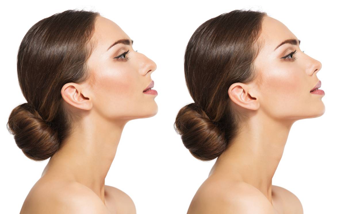 featured image for stages of rhinoplasty swelling post-surgery