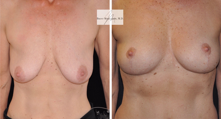Breast Lift