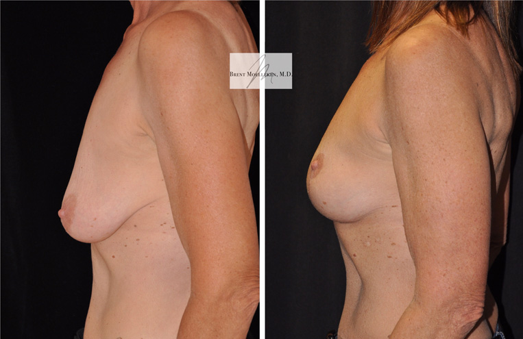 Breast Lift