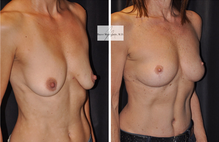 Breast Lift