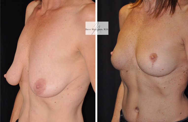 Breast Lift