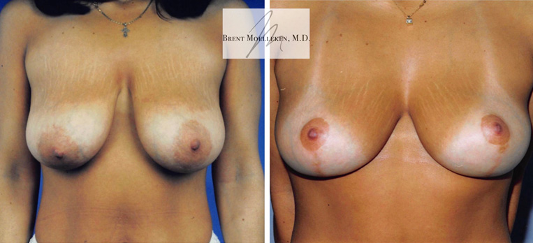 Breast lift