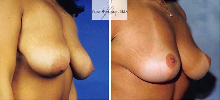 Breast lift