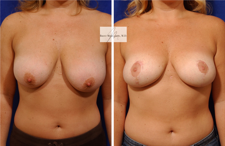 Breast Lift: 3 months post-op