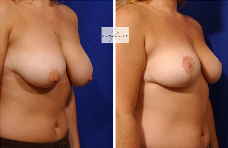 Breast Lift: 3 months post-op