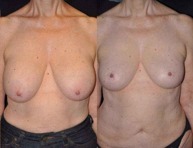 Removal of breast implants, breast lift